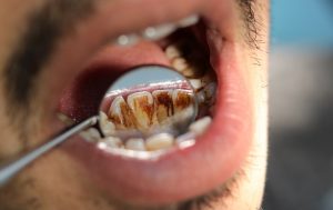 Dental hygienist preparing cleaning tools