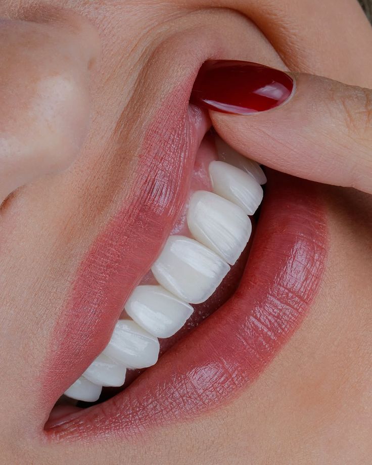 Smile design session for veneers